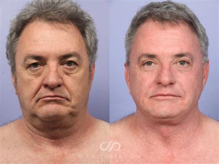 Yasmin Finney Surgery Before And After Photo: Transformation Update